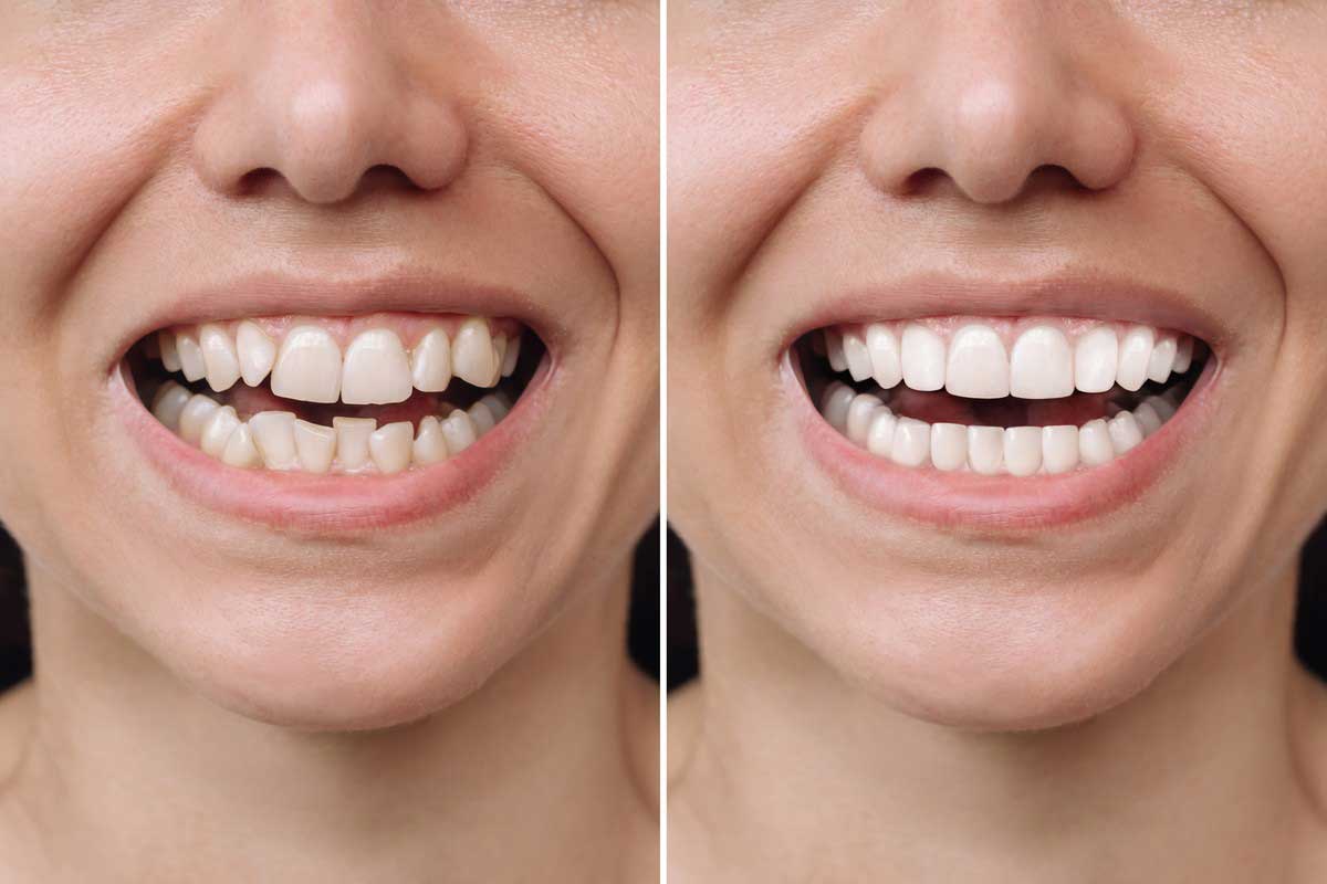 Bodrum Ortodonti Tedavisi: Şeffaf Plak ve Invisalign Kimler İçin Uygundur?