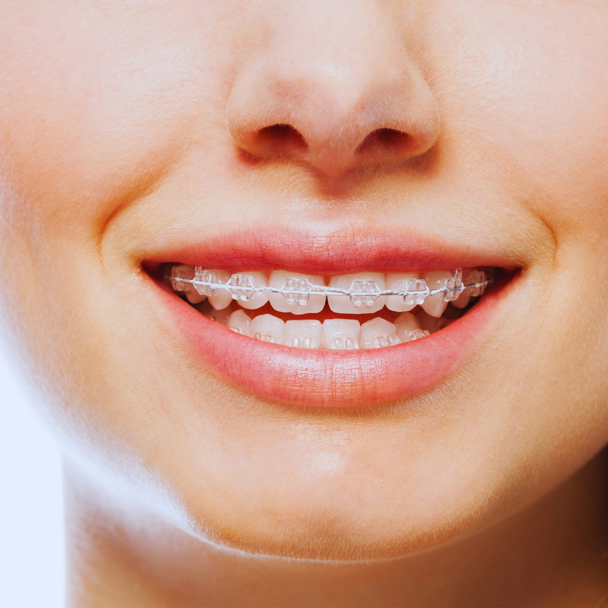 Seramik Diş Teli Tedavisi