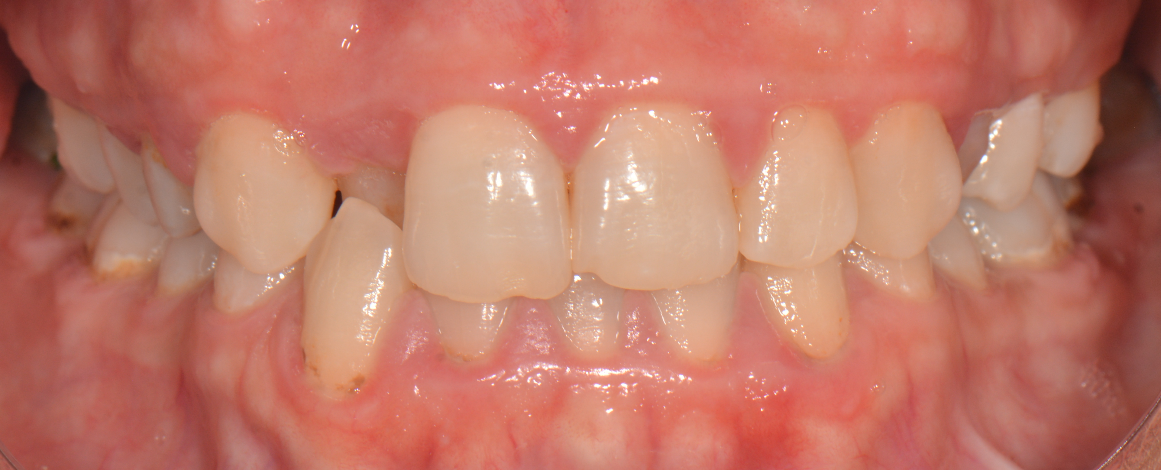 Problem: Derin kapanış öncesi