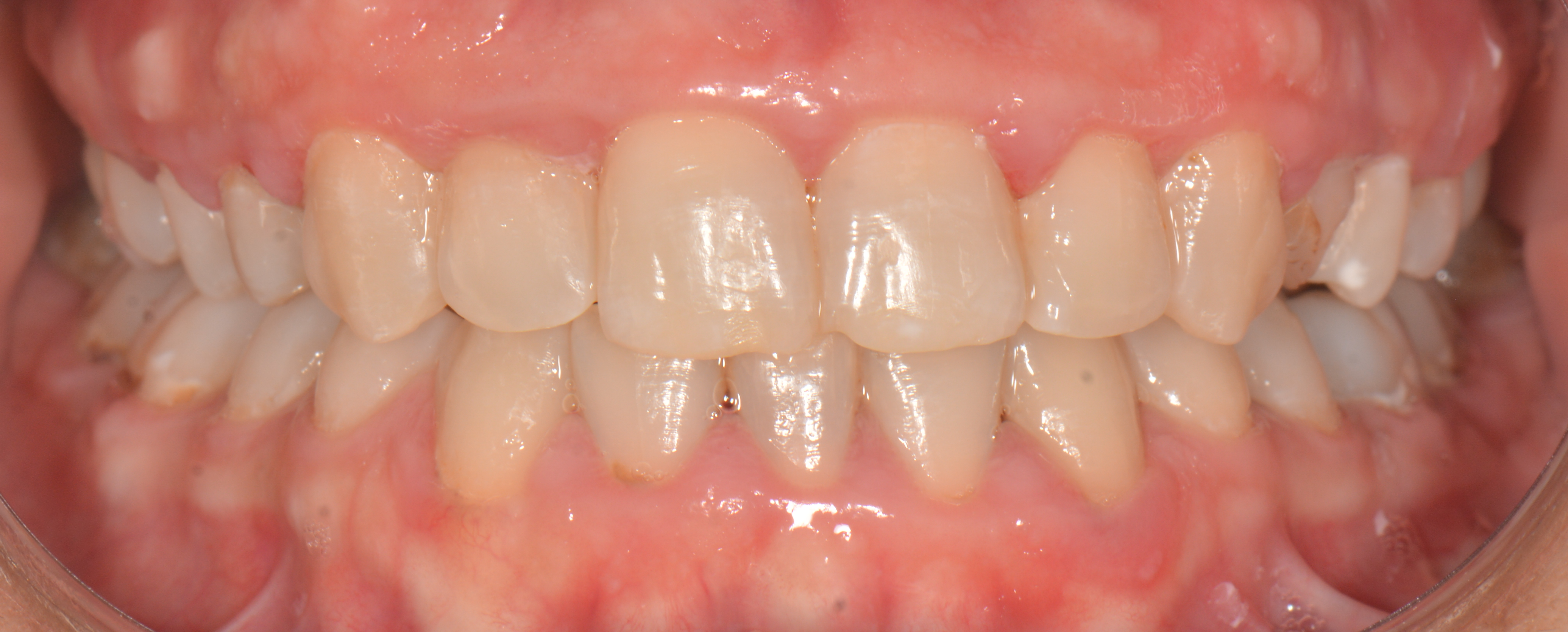 Problem: Derin kapanış sonrası