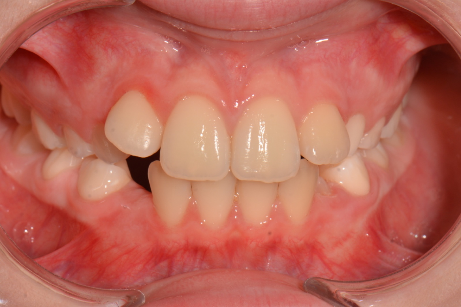 Şeffaf Plak öncesi