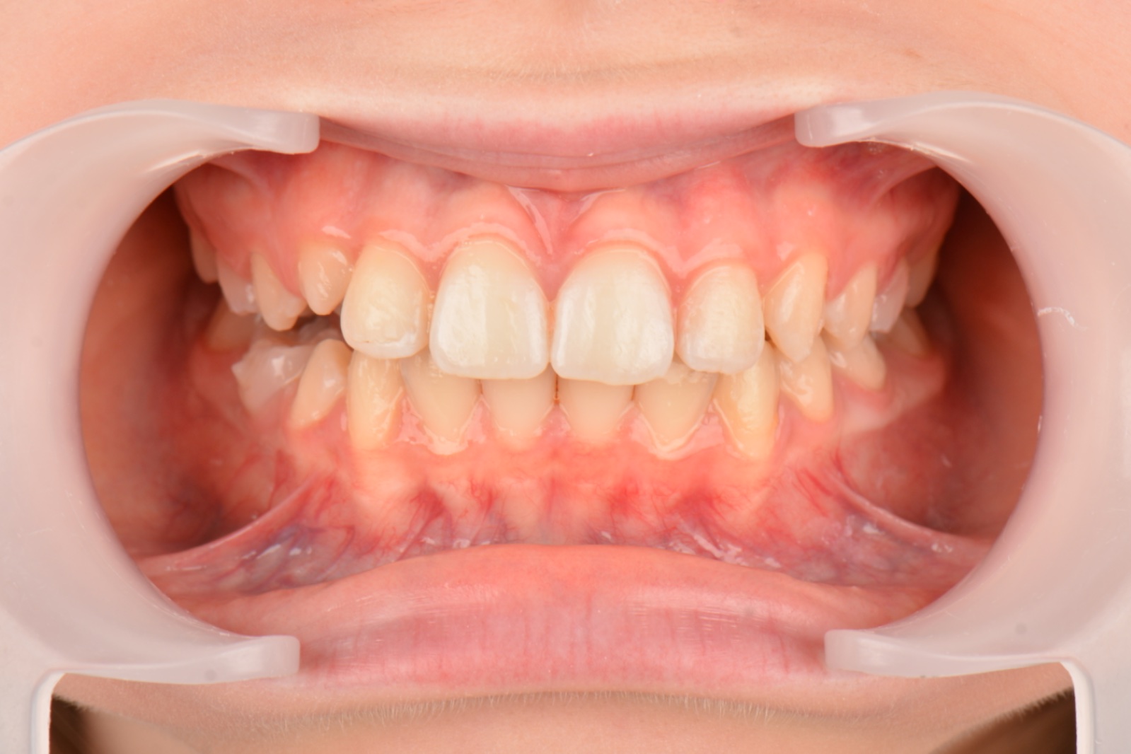 Çapraşıklık + dar üst çene sonrası