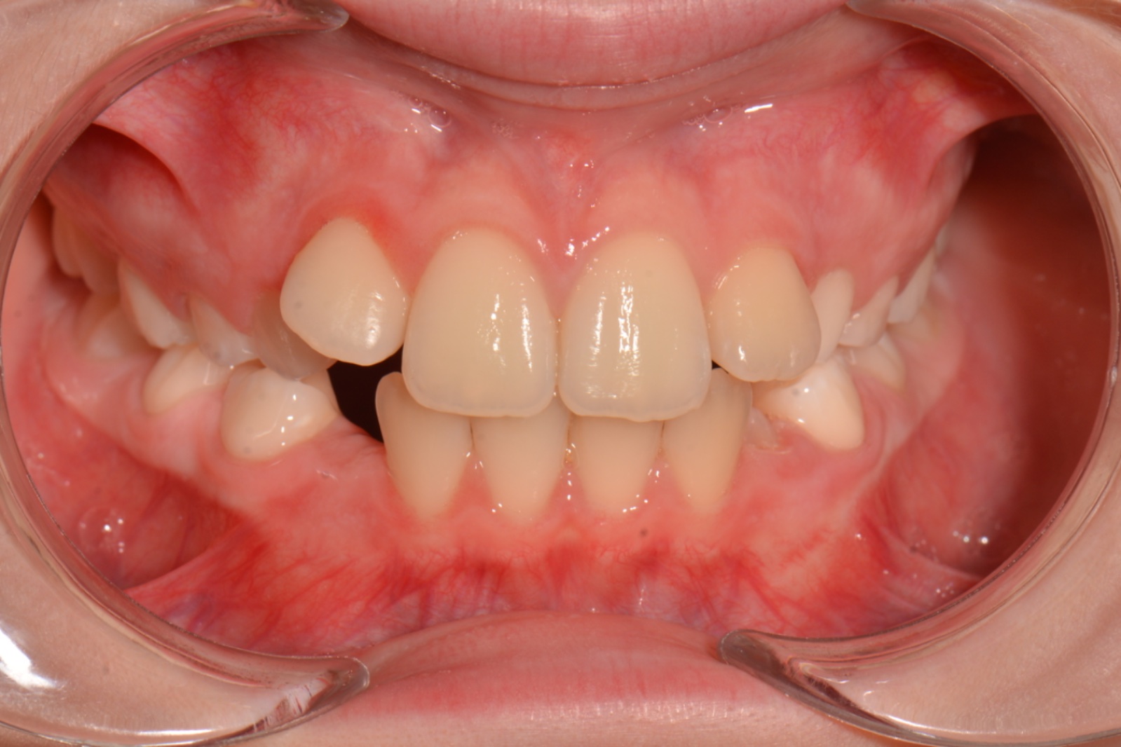 Çapraşıklık + dar üst çene öncesi