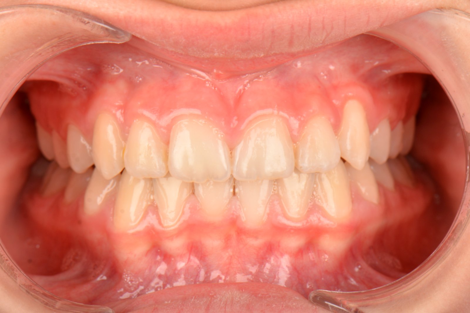 Şeffaf Plak Tedavisi sonrası