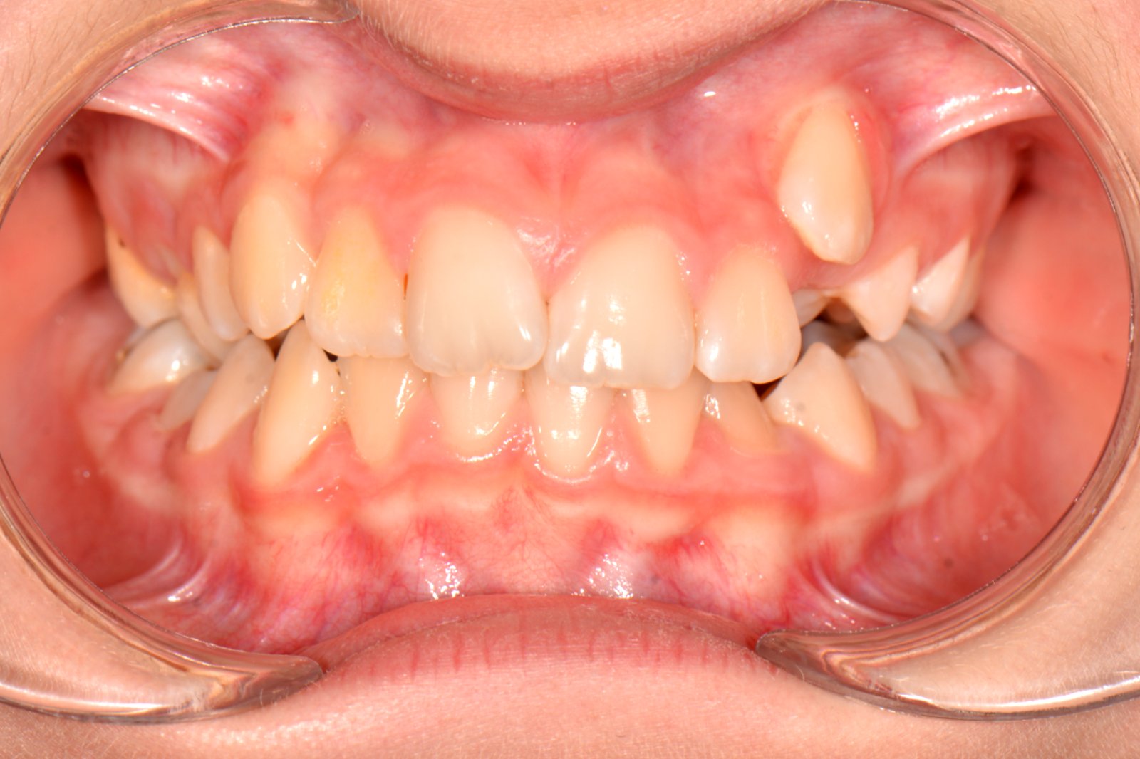 Şeffaf Plak Tedavisi öncesi
